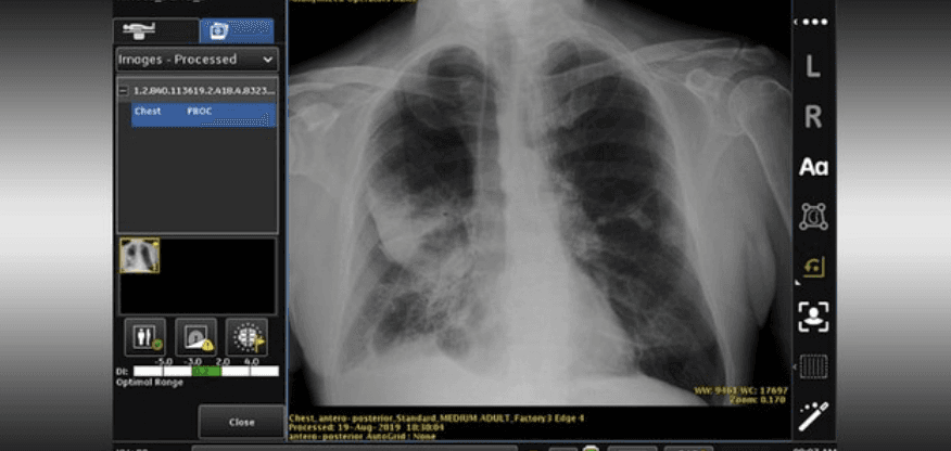 FDA Clears GE Healthcare's AI Triage Algorithm on X-Ray Device